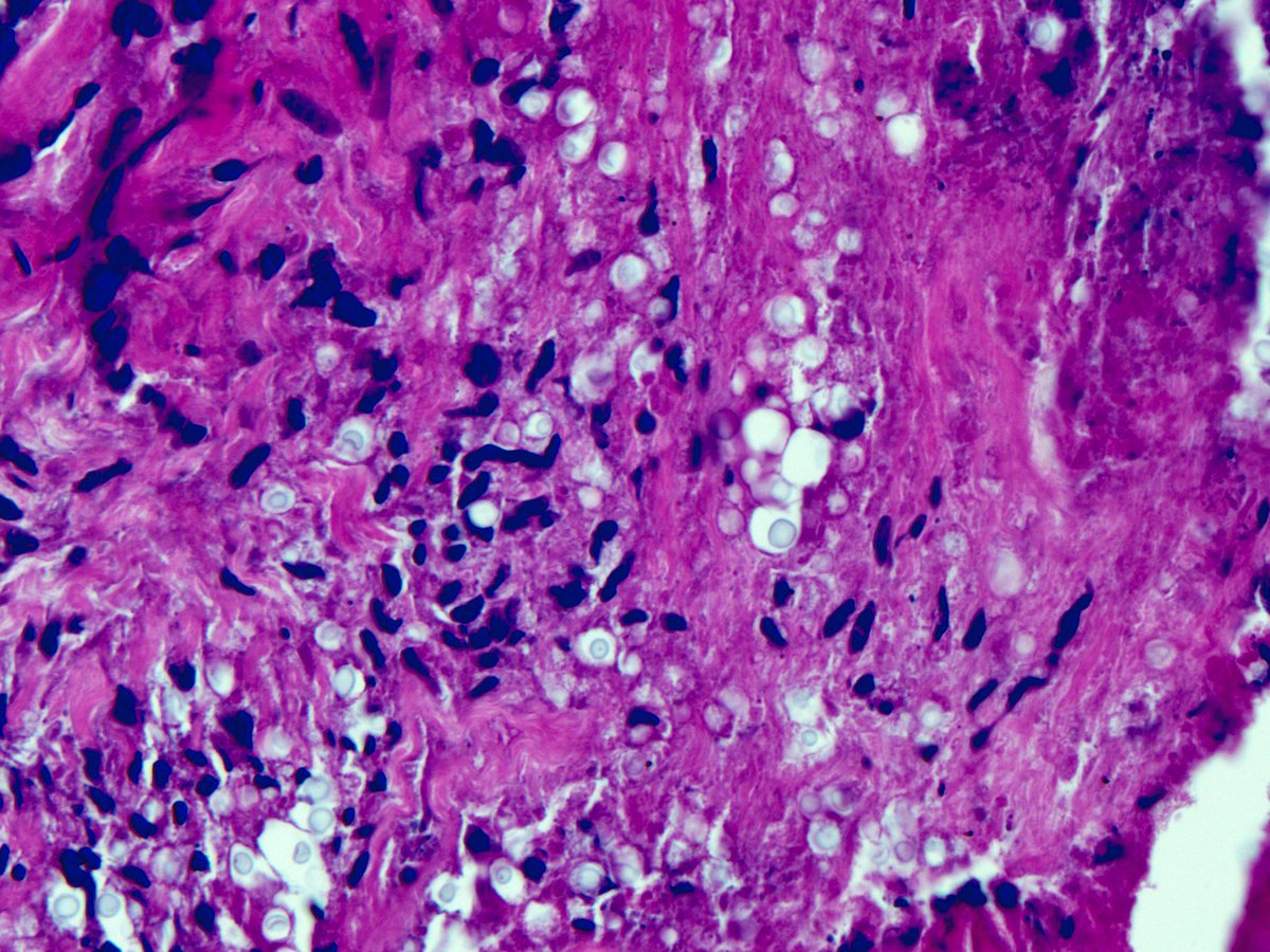 smlungpathguy's tweet photo. H&amp;E IS a special stain. Cryptococcus in necrotizing granuloma of lung, signed out on H&amp;E alone. 

#pathology #pulmpath #pathbugs #crittersontwitter 

See below for a 127-tweet magnum opus #Tweetorial on this fungus (bypasses Twitter’s word limit)  
https://t.co/HVBI10RSWn https://t.co/vRjohz1GWg