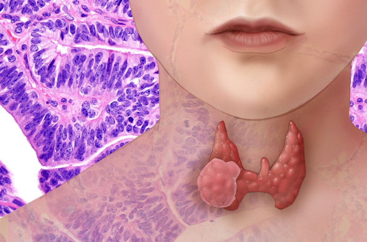 theNCI's tweet photo. What are the latest advances in research on thyroid cancer? Here's a summary: https://t.co/aRrwuaDFgx #thyroidcancer https://t.co/ZDbMbK6xTI