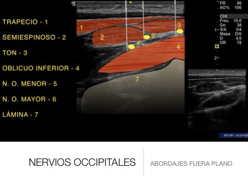 Abordajes ecoguiados para poder realizar neuromodulacion percutánea  en la región occipital en zona de anastomosis de las raíces de C1,C2,C3 y a veces C4 (plexo cervical de Cruveilhier). GON, TON y Occipital menor #cursoneuroeje #centrosanttelm
