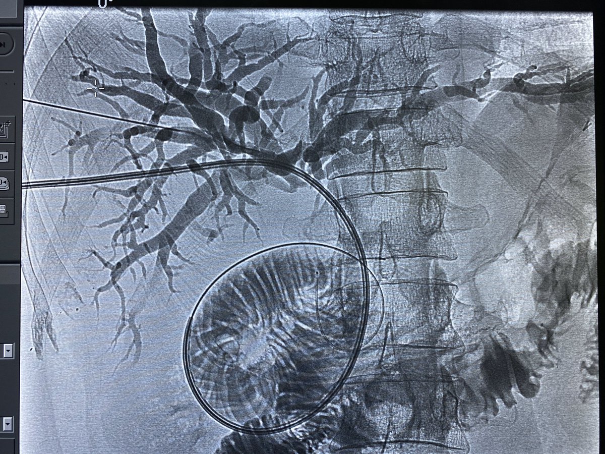 iRadHUKM's tweet photo. PTBD for biliary obstruction. Hx of pancreatic Ca, with hepaticojejunostomy stricture. #PTBD #biliaryobstruction #cancer #IRad https://t.co/8mfDGiFlHS