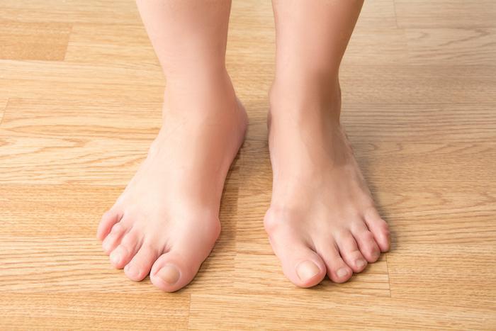 WashFootAnkle's tweet photo. Bunions are a common problem that can be quite damaging to the feet if left untreated. Don't ignore bunion pain; find a solution today by clicking here to learn more! https://t.co/id5seWoO06 https://t.co/mJkYjPETJA
