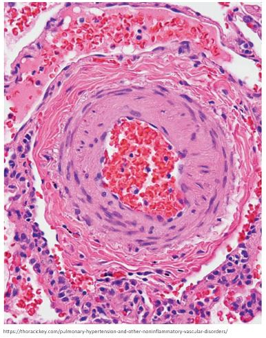 1/ Pulmonary vasodilators are generally not used for patients with pulmonary hypertension due to COPD, even if severe. Why would that be? #medtwitter #medthread #tweetorial