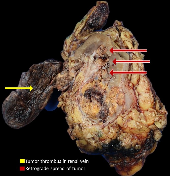 UTSW_GUPath's tweet photo. Retrograde venous spread of RCC
Growth of variably-sized tumor nodules in a non‐contiguous fashion, separate from the main tumor. This results from the occlusion of venous outflow by obstructing renal vein tumor thrombus.
Thanks to @TRood12
#GUpath https://t.co/CiigEp7Ic5
