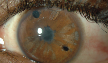 Dogma vs Data: Placement of Laser Peripheral Iridotomy; Does improved understanding of dysphotopsia support traditional superior placement? By Manjool Shah, MD glaucomaphysician.net/issues/2019/de…