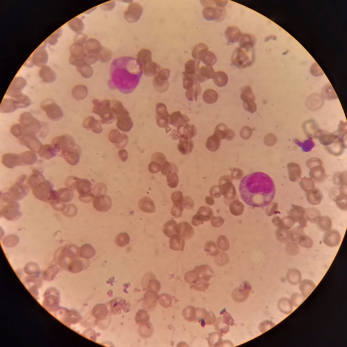 I guess I am lucky to see the second case of chediak higashi during my career. This case is indeed special  with the oncogoing hemophagocytosis (phagocytic vacuole in the myeloid series).