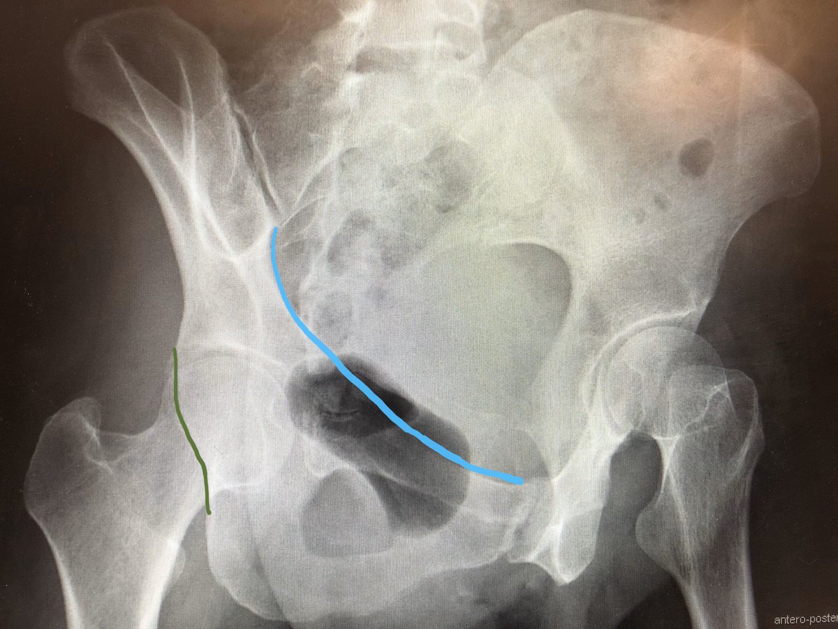 InvictaOrtho's tweet photo. Judet views used for acetabular fractures. Obturator oblique shows anterior column (blue) &amp; posterior wall (green). Iliac oblique shows posterior column (pink) &amp; anterior wall (yellow). Because pelvis is tilted for view, iliac oblique of one side = obturator oblique of the other. https://t.co/bsCORaa06q