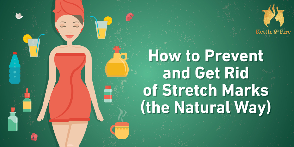 How to Get Rid of Stretch Marks and Prevent Them (the Natural Way) bit.ly/2FNmbmY
