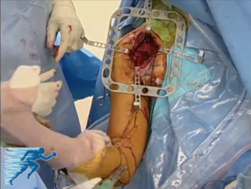 MillettMD's tweet image. In this video, Colorado shoulder surgeon Dr. Peter Millett demonstrates a #Latarjetprocedure

This procedure is used as treatment for shoulder instability: medilink.us/0inn 

#orthotwitter #medtwitter