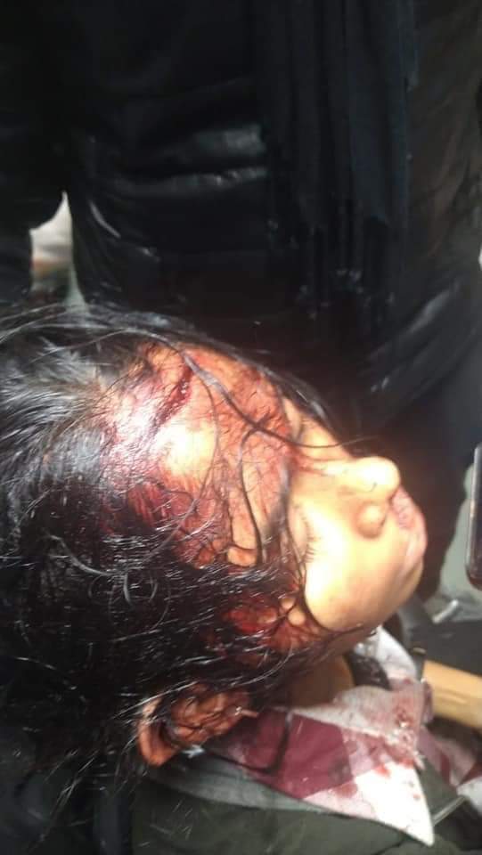 aishe_ghosh's tweet photo. It scares me. Traumatises me. Still, let these pictures sink in.
But I want to ask everyone, I had to face an attempt to murder. Is this why, Delhi Police named me as a suspect ?

#DelhiPoliceLies https://t.co/liGfVN3eq0