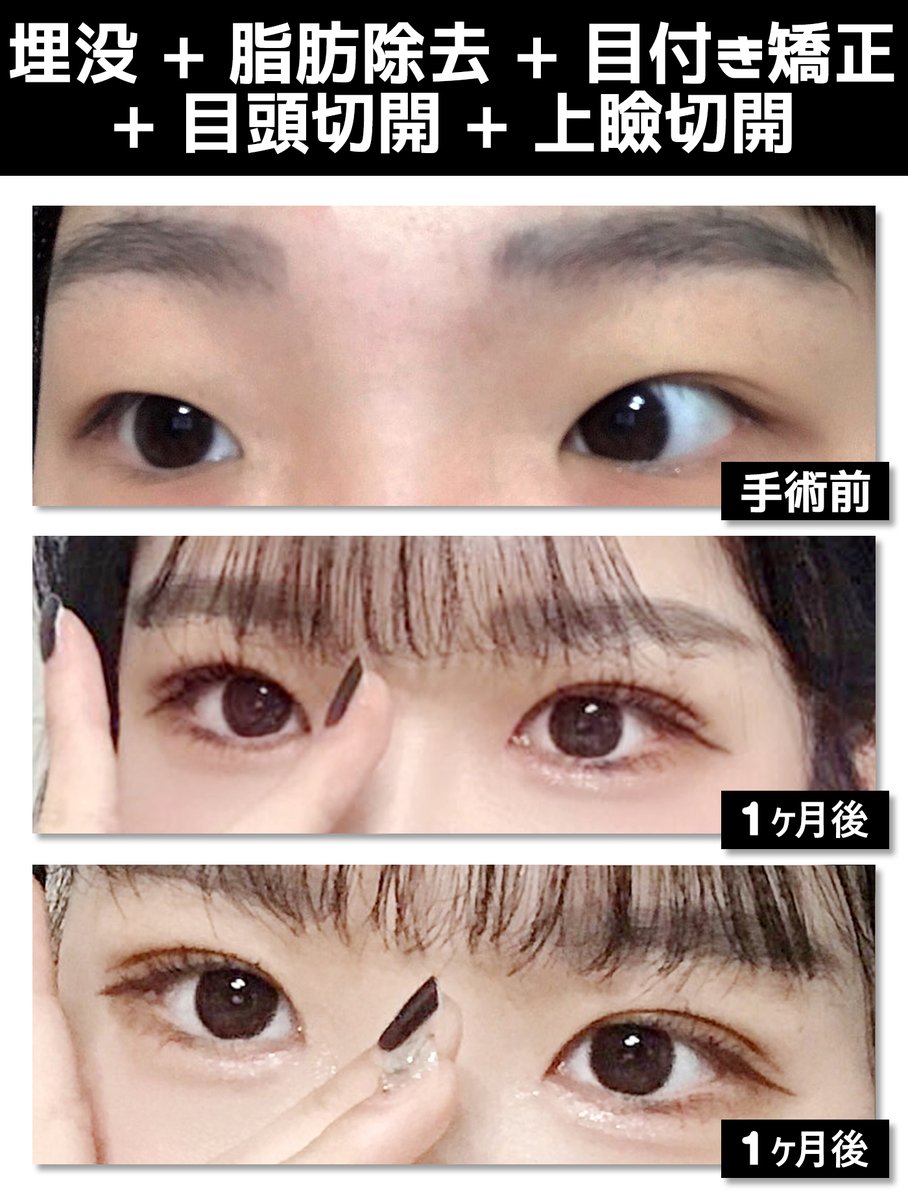シナジー整形外科 در توییتر 目の手術の症例写真 手術部位 埋没 目付き矯正 脂肪除去 目頭切開 上瞼切開 Hp T Co O5idaqebyu Line Id Pgs7984p シナジー整形外科 目整形 切開 埋没 韓国 T Co E8gyrvi3mq