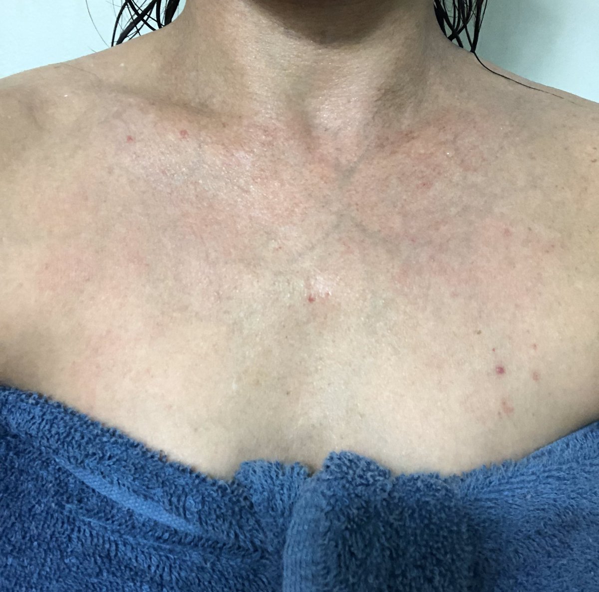 I decided to make breastmilk soap to help my moms eczema and these are the results after just 7 days of using it! It has also helped my sisters acne in just two weeks! Her acne did a complete 180! If you’re interested in buying any please message me! :)