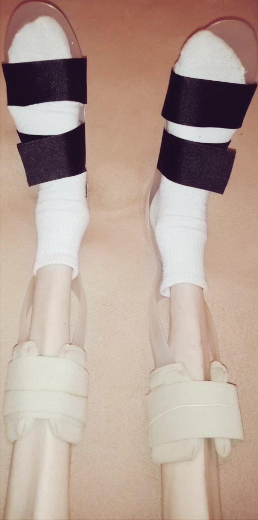quarantine_13's tweet photo. #orthesis #ortheses
#polyneuropathy https://t.co/ACXAxtQT17