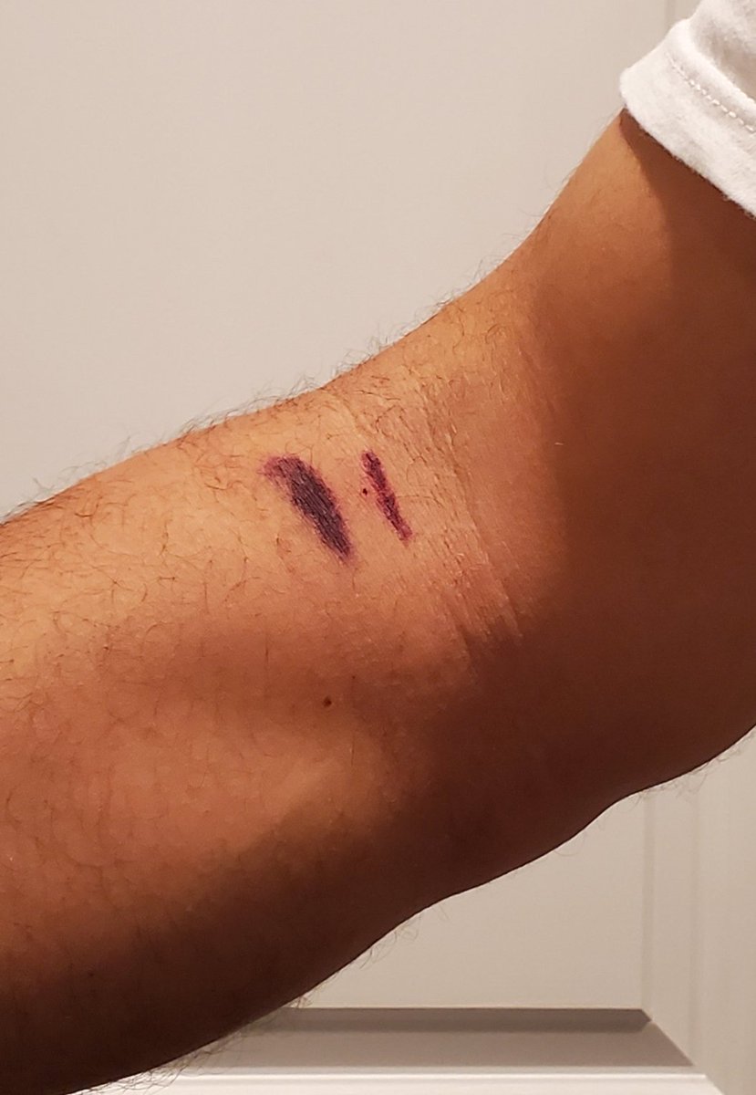 tamer_hadi's tweet photo. Pretty sure one's arm should not look like this after a blood donation #PhlebotomyFail https://t.co/IkBQbM1iAq
