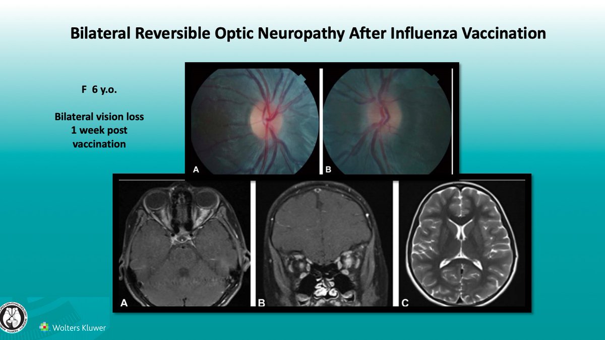 Bilateral Reversible Optic Neuropathy After Influenza Vaccination
Article: bit.ly/33LazvV
#brain #eye #vision #research #neuro #neurology #ophthalmology #ophtho #influenza #vaccination #vaccine #OpticNeuropathy #MRI #imaging