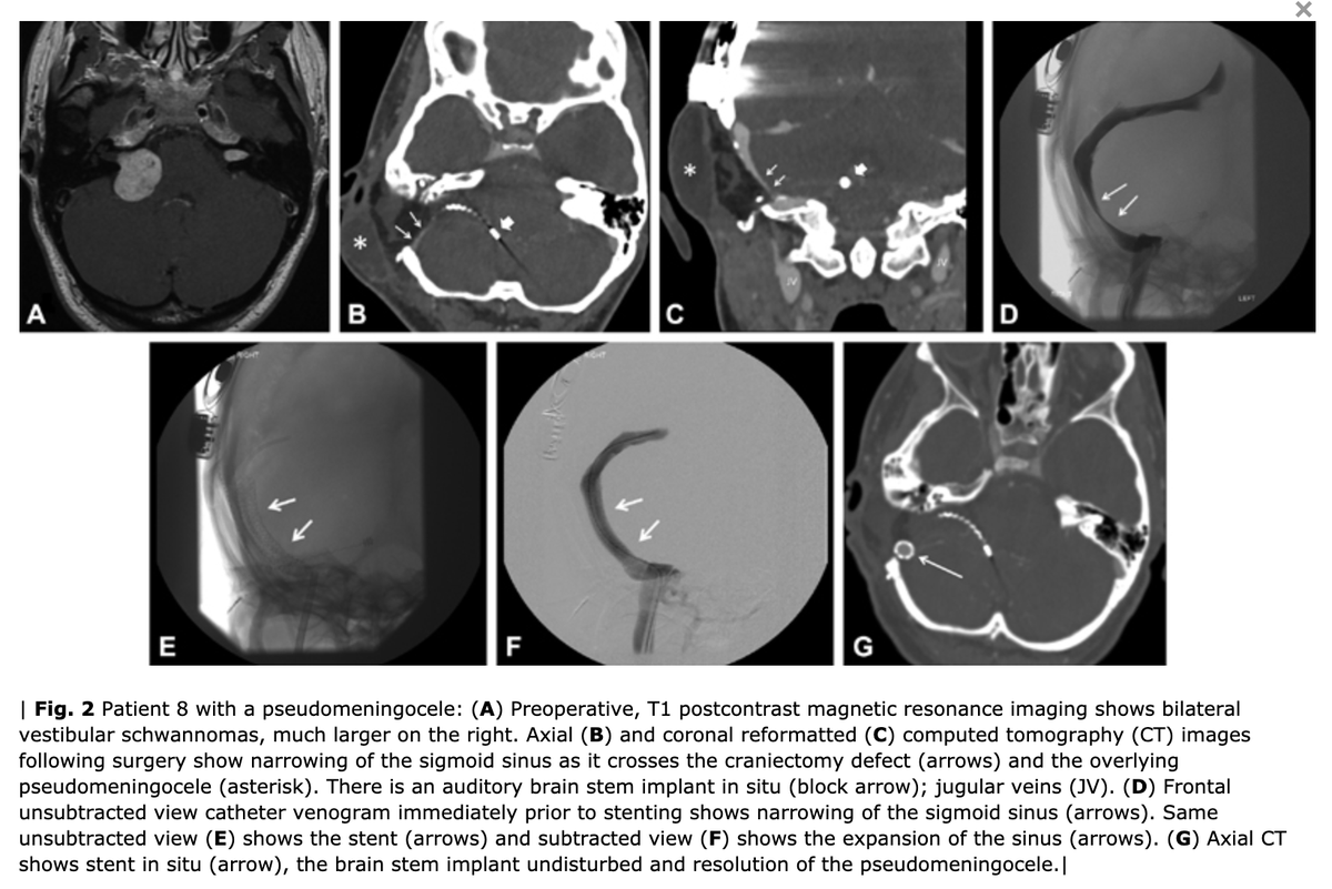 NASBSorg's tweet photo. #JNLSB_Online
Headache, Cerebrospinal Fluid Leaks, and Pseudomeningoceles after Resection of Vestibular Schwannomas: Efficacy of Venous Sinus Stenting Suggests Cranial Venous Outflow Compromise
#nsgy #ent #VS #translab #endovascular #complications
https://t.co/xJjZin3gJ0 https://t.co/O85YQuwGyw