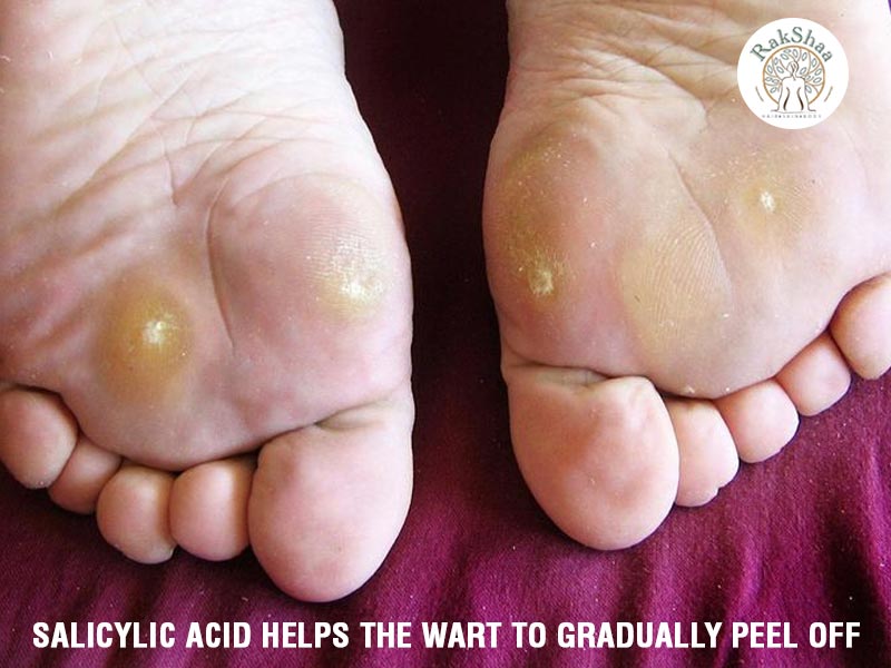 RakshaaSkin's tweet photo. Salicylic acid helps the wart to gradually peel off

#Salicylic #Acid #PeelOff  #RakshaaSkinClinic #SkinClinic #SkinClinicInDelhi #Delhi #DermatologistInDelhi #DrRakeshJangra

https://t.co/sEctpzbIwK https://t.co/DA6FCwnOLu