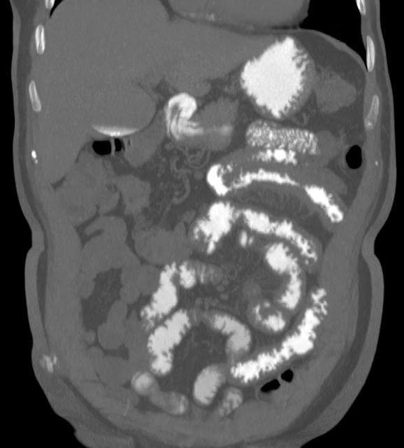 thexraydoctor's tweet photo. Crohn's disease
https://t.co/hrRIC37kDE
#xrayoftheweek #FOAMRad #FOAMed #meded #radres #radreg #medtwitter https://t.co/QxStAzwilU