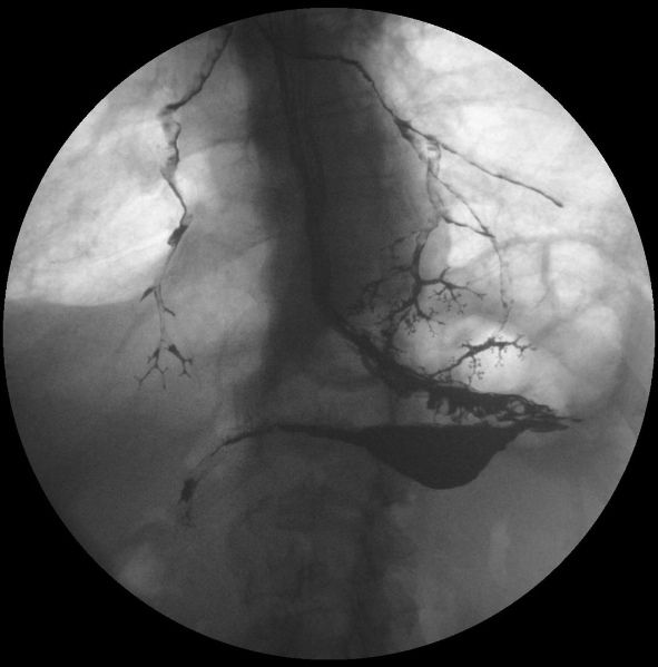 thexraydoctor's tweet photo. Barium aspiration
https://t.co/zK7glHHn48
#xrayoftheweek #FOAMRad #FOAMed #meded #radres #radreg #medtwitter https://t.co/wBPn8lTfE2