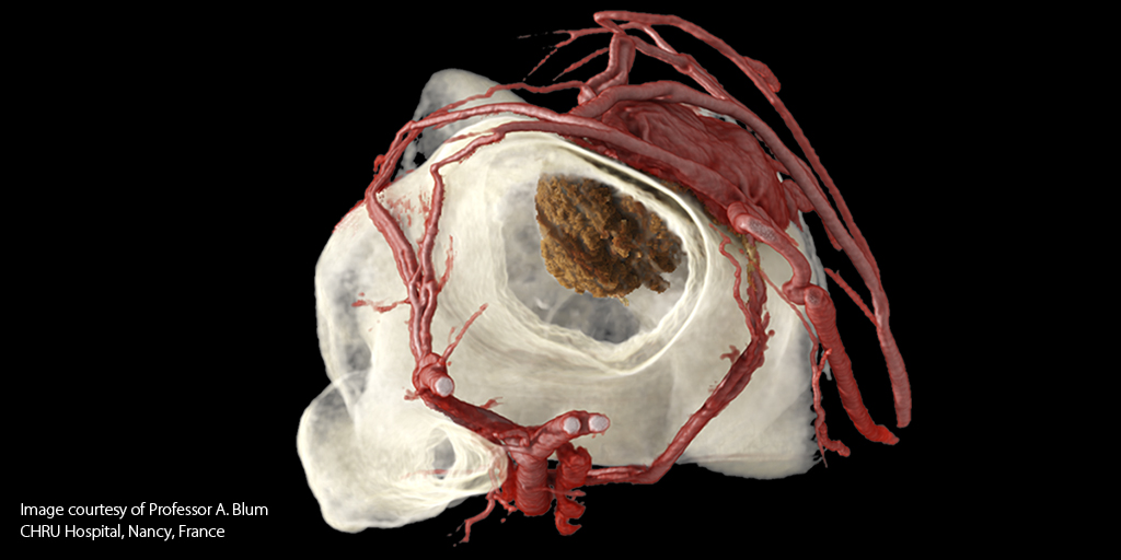 CanonMedicalEU's tweet photo. See how #GlobalIllumination lets you visualize the vasculature AND the osteosarcoma simultaneously? It’s the new standard in advanced visualization. #MadePossible

More: https://t.co/DJ0uh8mobu 

In picture: Osteosarcoma

#advancedvisualisation #photorealistic #volumerendering https://t.co/X5StvF2kWp