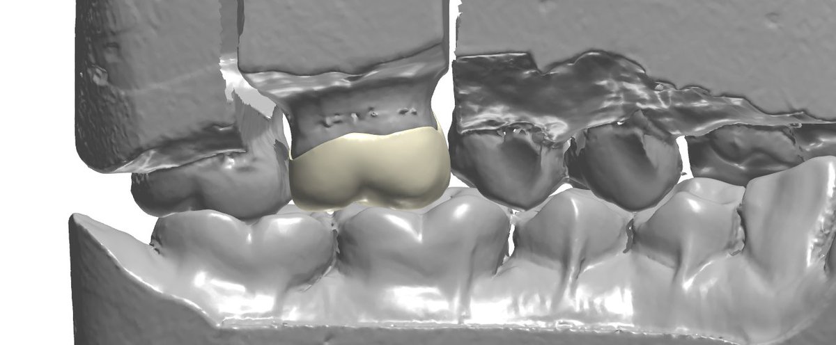 ImpChenCAD's tweet photo. Professional design, excellent service, affordable price from Ian Dental Design Lab https://t.co/JrBjszJn08