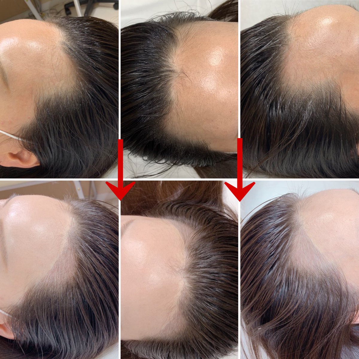 アートメイク Brownee Sur Twitter 長年の悩みだったm字がたった一度のヘアラインアートメークで目立たなくなり オールバックポニーテールも出来る様になったと喜ばれたお客様の施術直後の写真です Line T Co Thubutsnfh アートメイク 眉毛アート