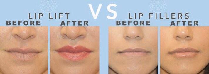 Филлер в губы сколько мл. Схема введения филлера в скулы. Формы губ. Контурная пластика ювидерм. Губы ботокс до и после фото.