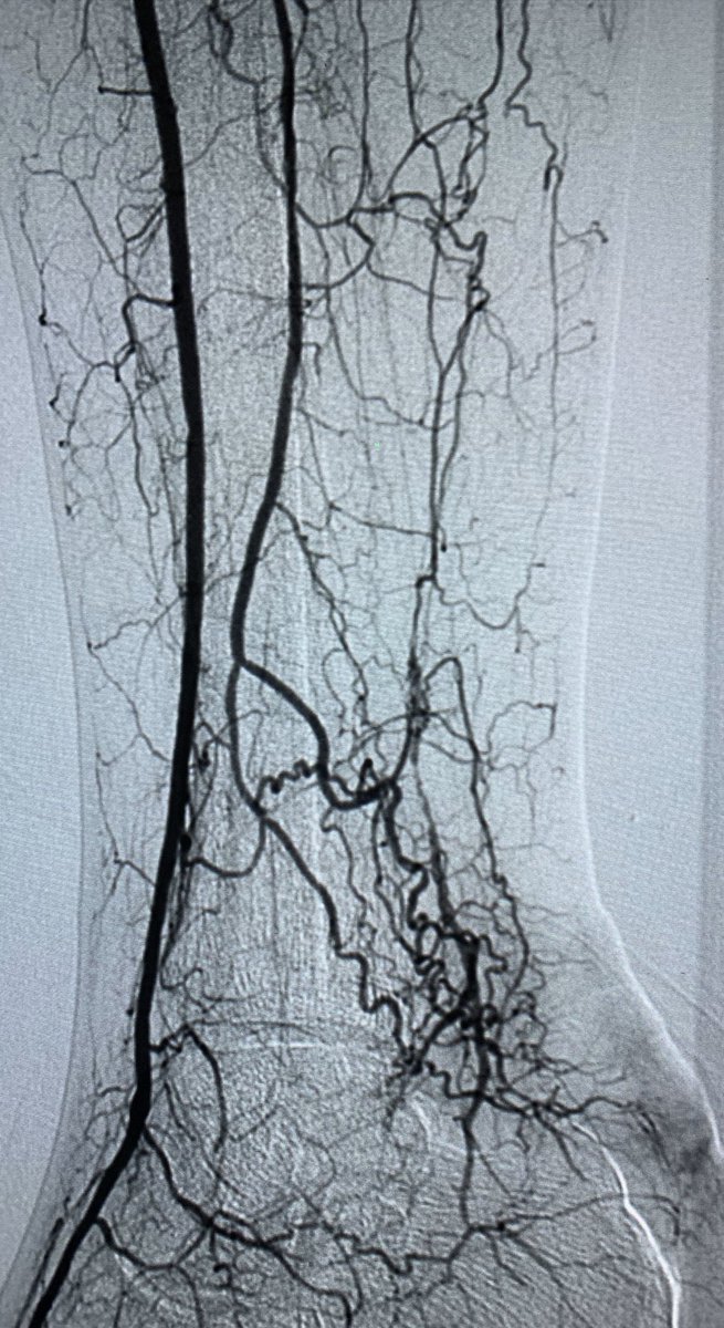 t_intheleadcoat's tweet photo. Non healing heel #ulcer. PT #CTO long segment. #pedalloop incomplete. Crossed and #PTA done. #irad @SIRspecialists @SIRRFS @SIR_ECS @AMPSymposium #limbsalvage #PAD #wounds @CLI_Global @CLIfighters @EVToday @NCVHonline @WIIGS2 @CAIRads @ISVIRIndia @ISETNews #twittIR https://t.co/80f8Klp6ma