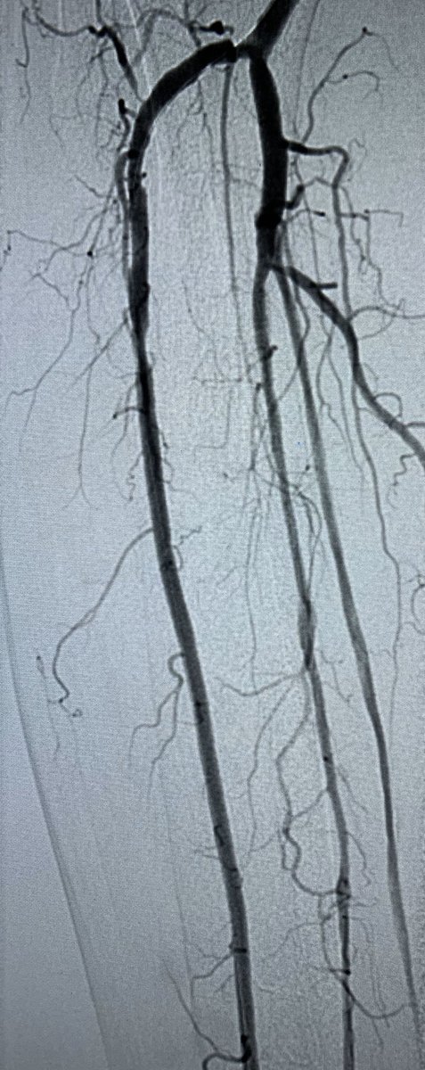 t_intheleadcoat's tweet photo. Non healing heel #ulcer. PT #CTO long segment. #pedalloop incomplete. Crossed and #PTA done. #irad @SIRspecialists @SIRRFS @SIR_ECS @AMPSymposium #limbsalvage #PAD #wounds @CLI_Global @CLIfighters @EVToday @NCVHonline @WIIGS2 @CAIRads @ISVIRIndia @ISETNews #twittIR https://t.co/80f8Klp6ma