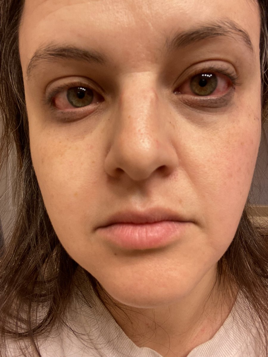 JenLuvsReviews's tweet photo. Holy crap! I used Babe Lash growth serum last night and woke up like this. No itching, just a little achy. Never had this happen with a lash serum before! https://t.co/fsxKPP4INg