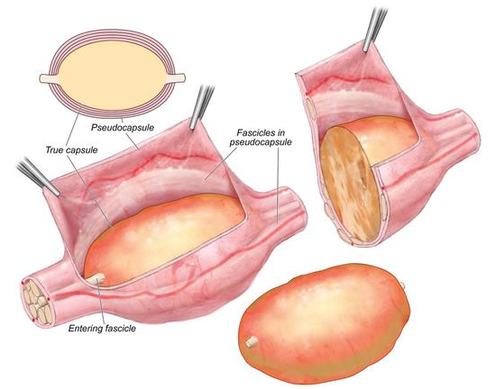 NeurosurgeryCNS's tweet photo. #ONSNew Stone and Spinner describe a technique to find the correct intraneural dissection plane based on a quantified yellow appearance during resection of benign peripheral nerve sheath tumors https://t.co/grXv1xNP7F
#Benignperipheralnervesheathtumor #Neurofibroma #Schwannoma https://t.co/okYQinSgFA