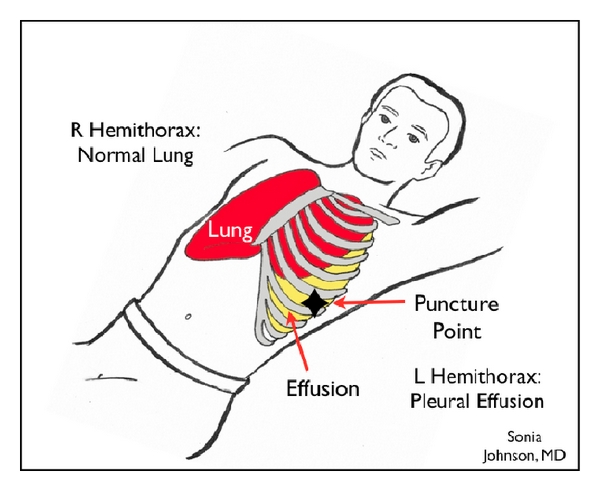 aldorodrigo's tweet image. In Ultrasound #POCUS guided #thoracocentesis. My personal preference is to use the supine position with head and chest elevated at 30-45°. 

dx.doi.org/10.5402/2012/6…
