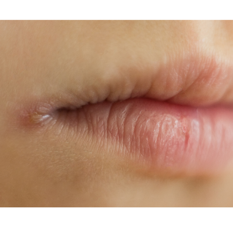 ACDS_Dermatitis's tweet photo. Almost 1 in 5 cases of cheilitis are due to allergic contact dermatitis. Most common culprits are personal products, fragrances, and sunscreens. #liprash #cheilitis #eczema #DermatitisJrnl https://t.co/aQGoBGnekh https://t.co/eqidL4SUwb