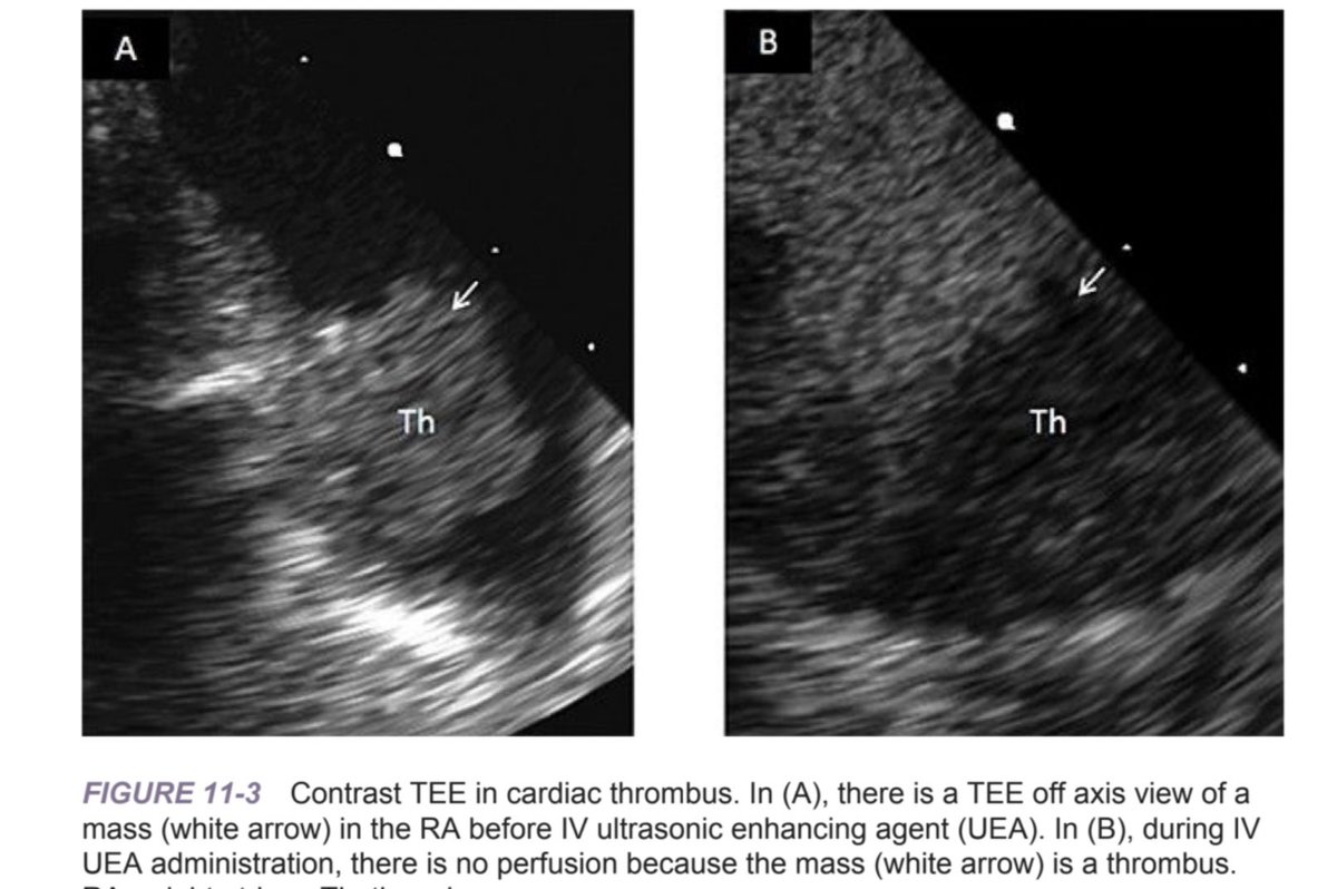 onco_cardiology's tweet photo. From new edition of Cancer and the Heart, happy to share our most recent book chapter on imaging &amp; cardiac tumors with @AliAgha44581042 &amp; @purviparwani. Figures including examples using #UEA TEE to assess for perfusion &amp; #whyCMR sarcoma. https://t.co/v1aqgzt2SV #CardioOnc https://t.co/MHLPufDv9Q