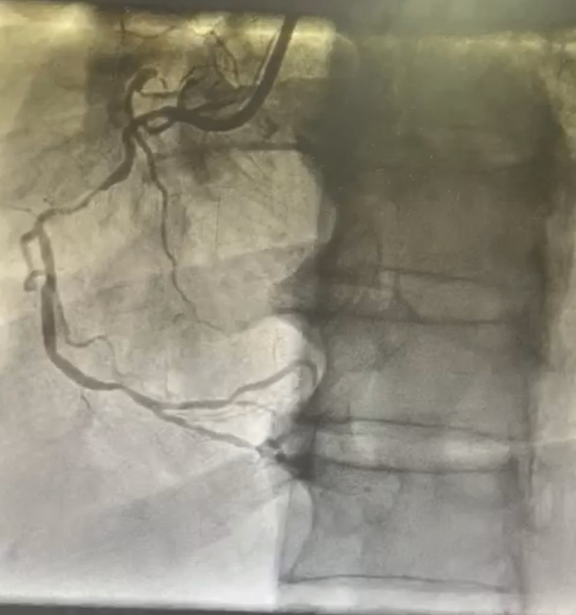 DrNayef1's tweet image. Today at PSCC Riyadh 
we used the new generation of Rotablator ROTAPRO
It was good and easy to use and friendly
The only drawback is the wire needs more work to improve it
Case went uneventful @PCRonline @RadialFirstBot @escardio @GisGulf 
@almoghairi @sacisforum  #RotaPro @TCTMD