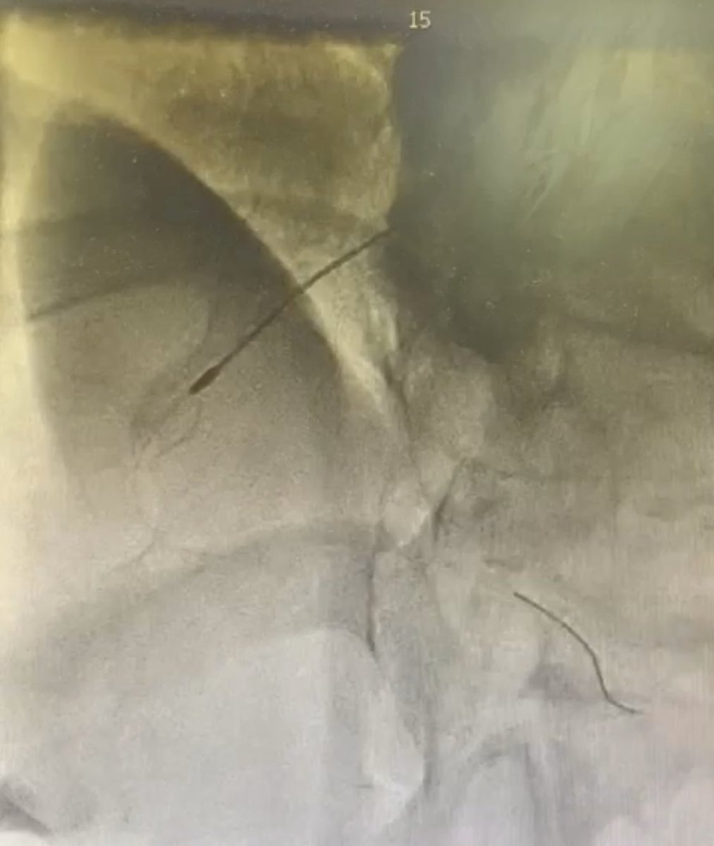 DrNayef1's tweet image. Today at PSCC Riyadh 
we used the new generation of Rotablator ROTAPRO
It was good and easy to use and friendly
The only drawback is the wire needs more work to improve it
Case went uneventful @PCRonline @RadialFirstBot @escardio @GisGulf 
@almoghairi @sacisforum  #RotaPro @TCTMD
