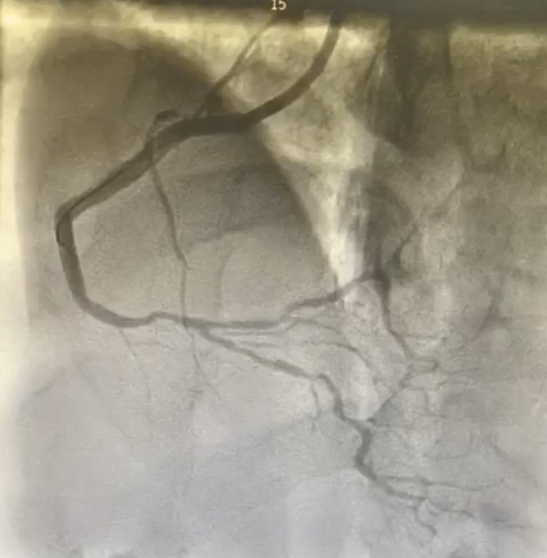 DrNayef1's tweet image. Today at PSCC Riyadh 
we used the new generation of Rotablator ROTAPRO
It was good and easy to use and friendly
The only drawback is the wire needs more work to improve it
Case went uneventful @PCRonline @RadialFirstBot @escardio @GisGulf 
@almoghairi @sacisforum  #RotaPro @TCTMD