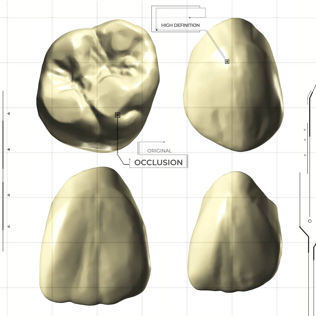 LorantStumpf's tweet photo. #digital, #dentistry, #cad, #cam, #digitaldentistry, #cerec, #3shape, #3shapetrios, #implants, #digitalsolution, #digitalrestoration, #dentallab, #printing, #exocad, #education, #technology, #digitalworkflow,#cadcamdentistry, #dentaltraining, #dentalschool, #crowns, #milling, https://t.co/YyTGv4qZPY