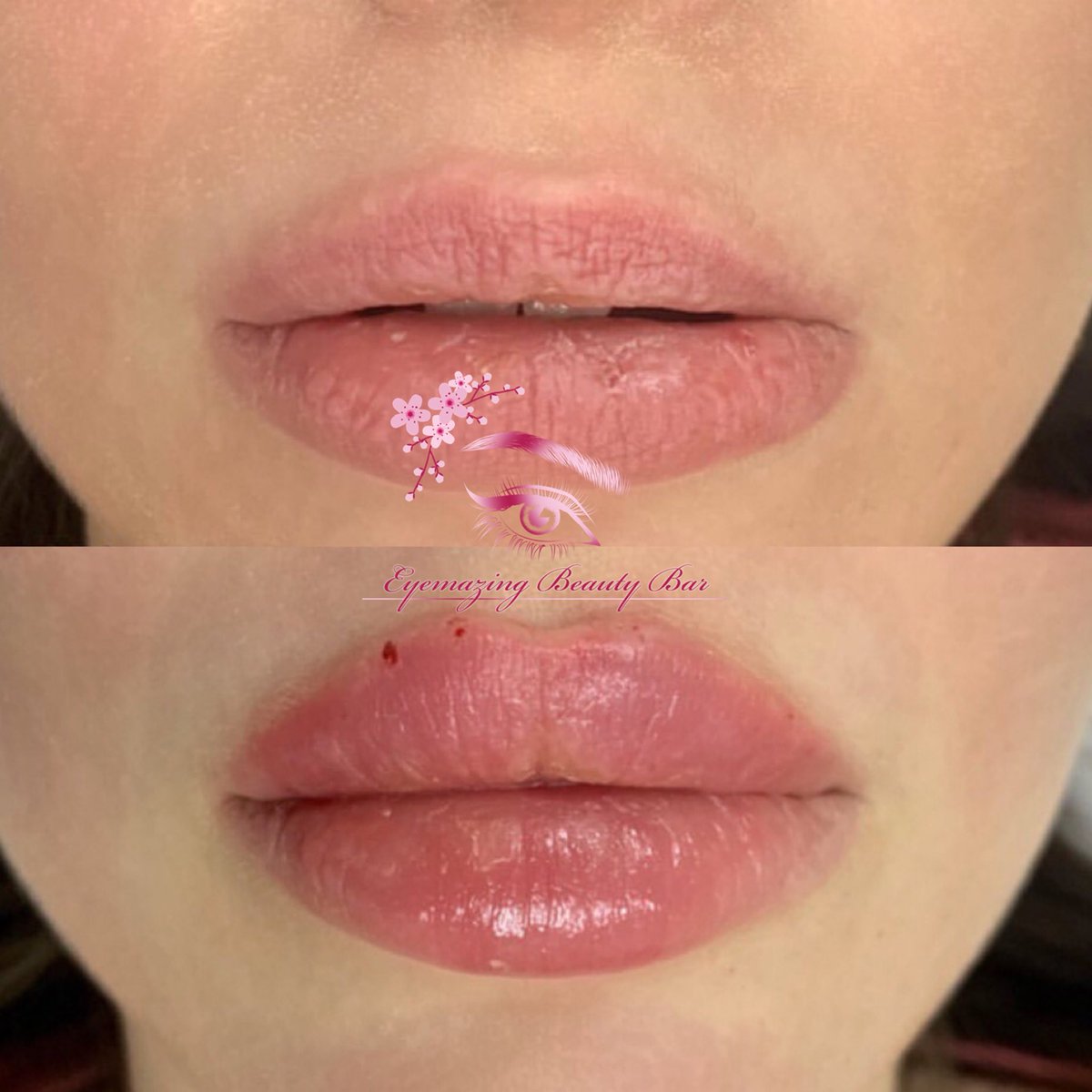 KYxAriel's tweet photo. #noneedle #lipfiller #eyemazingbeautybar #sandiego https://t.co/luQcWjNxGj