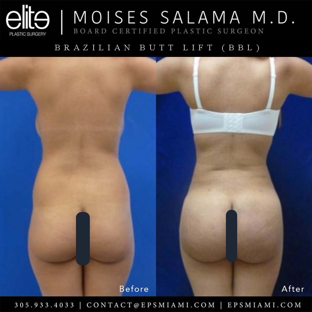 EPSMiami's tweet photo. What a transformation! 🍑🍑🍑 #brazilianbuttlift by Dr. Salama - 1300 cc per side. Visit our #BBL gallery for more #beforeandafter pics!
🌍 https://t.co/zRKQqiJHrF
📞 305.933.4033
📬 contact@epsmiami.com
#Buttockaugmentation #buttaugmentation #plasticsurgery https://t.co/FyQ2nZO1zd
