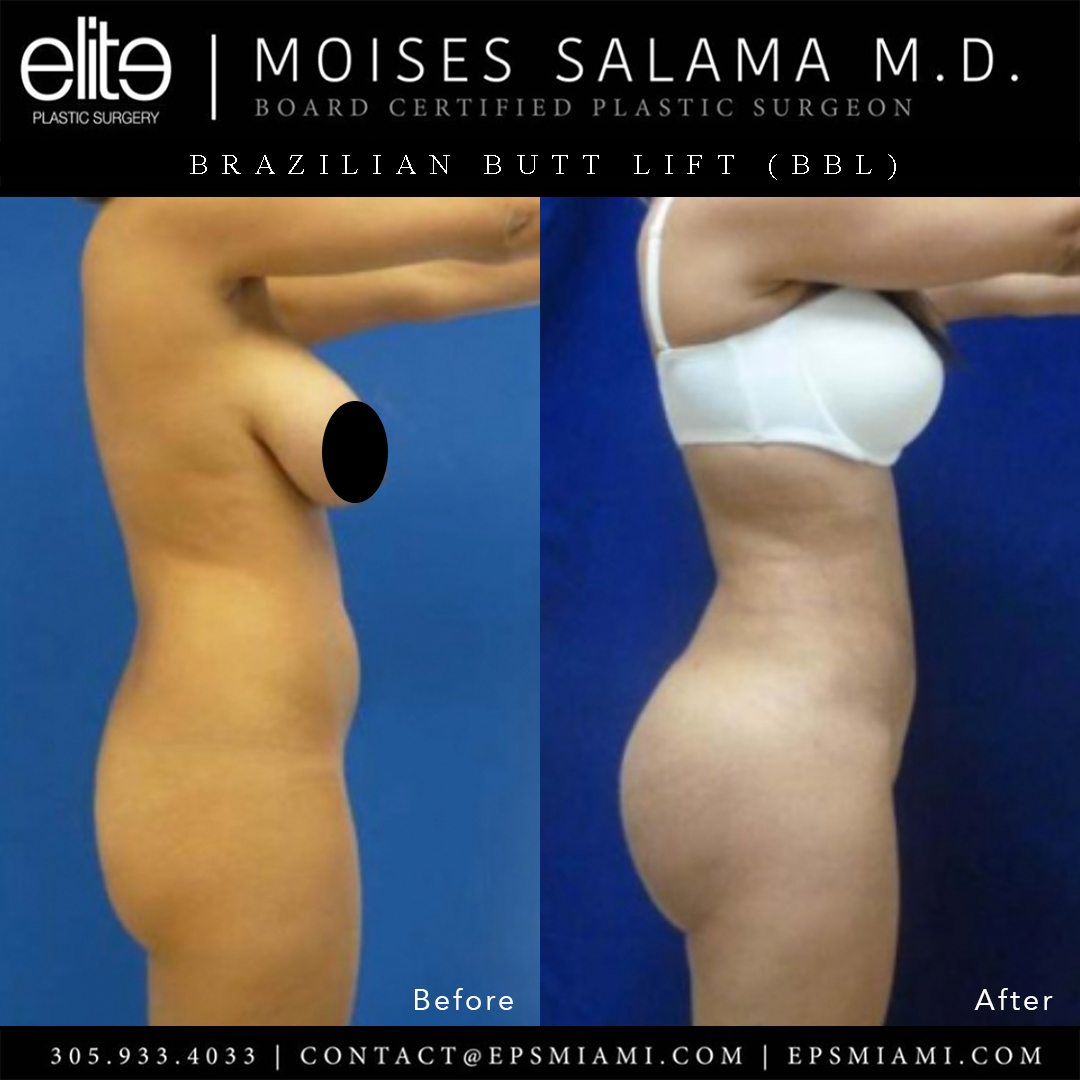 EPSMiami's tweet photo. What a transformation! 🍑🍑🍑 #brazilianbuttlift by Dr. Salama - 1300 cc per side. Visit our #BBL gallery for more #beforeandafter pics!
🌍 https://t.co/zRKQqiJHrF
📞 305.933.4033
📬 contact@epsmiami.com
#Buttockaugmentation #buttaugmentation #plasticsurgery https://t.co/FyQ2nZO1zd