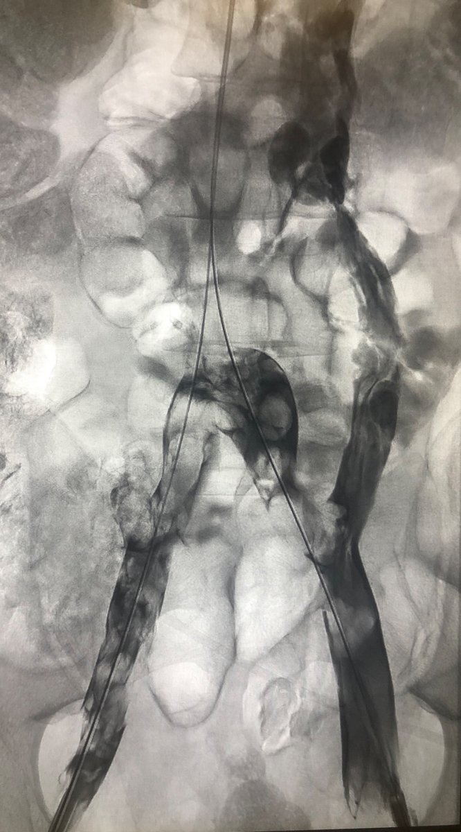 roblookstein's tweet photo. Live @MountSinaiIR IVC agenesis or chronic occlusion and atresia. Iliofemoral-Caval DVT. What to do? #Zelante and #double barrel #VIci stents. Completed in less than 2hrs #Singlesessiontherapy @SIRspecialists @SIRRFS https://t.co/85gmR4xtXI