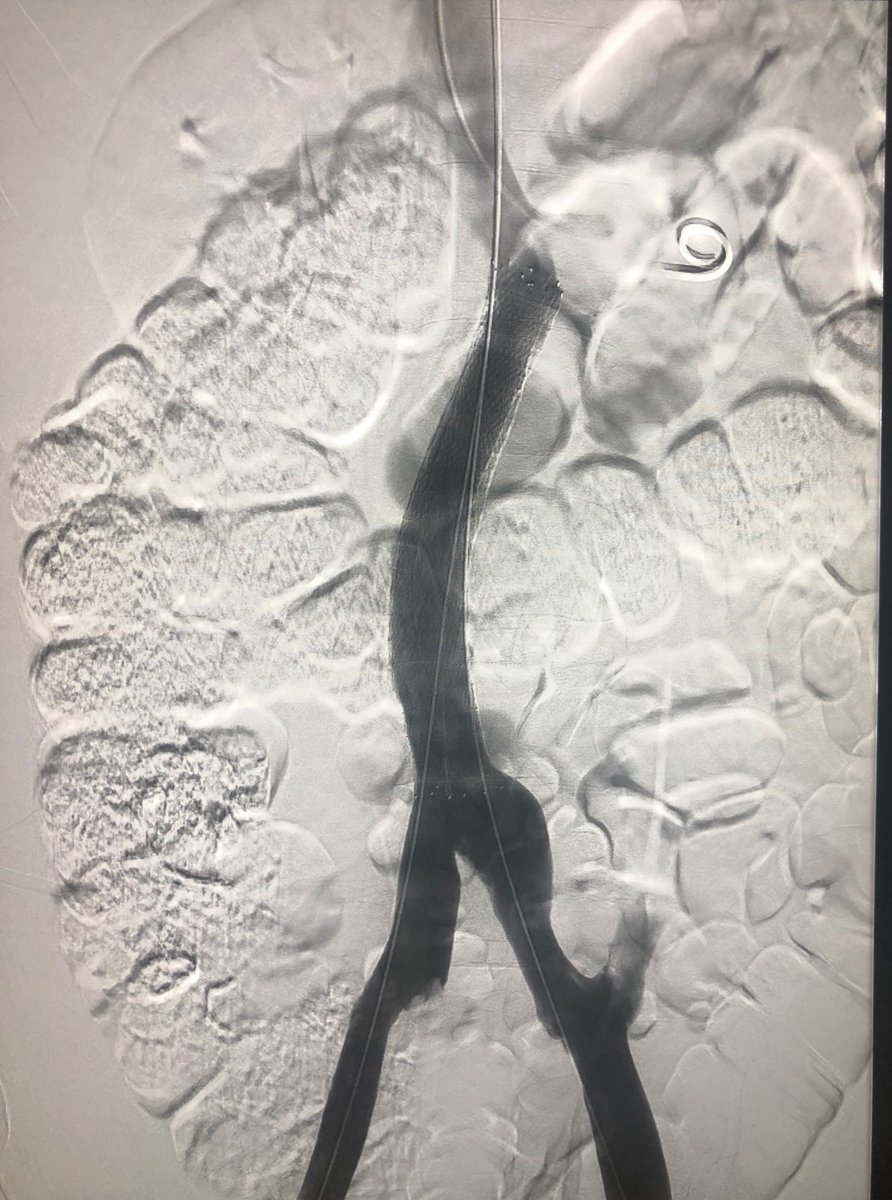 roblookstein's tweet photo. Live @MountSinaiIR IVC agenesis or chronic occlusion and atresia. Iliofemoral-Caval DVT. What to do? #Zelante and #double barrel #VIci stents. Completed in less than 2hrs #Singlesessiontherapy @SIRspecialists @SIRRFS https://t.co/85gmR4xtXI