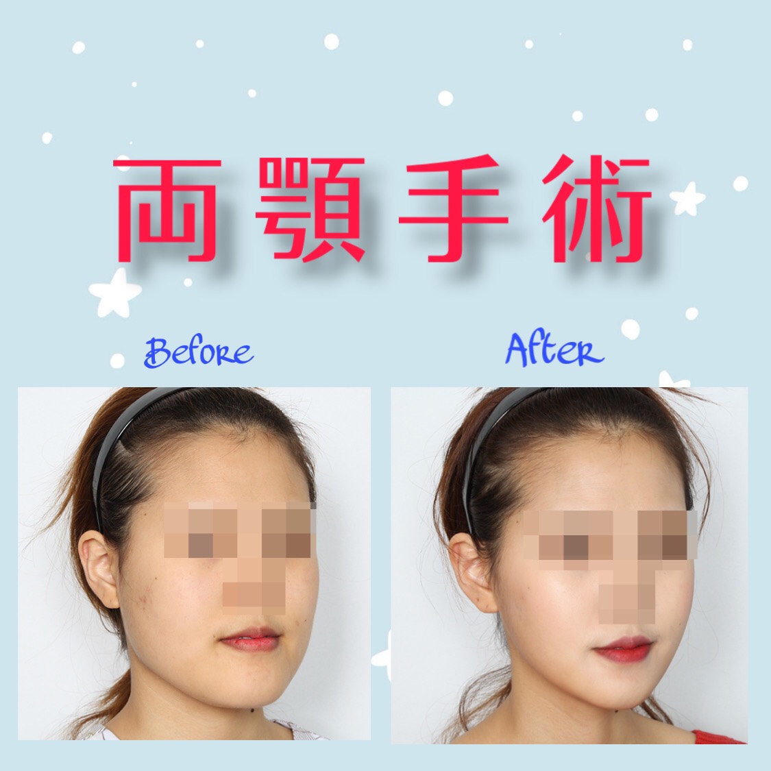 Facedesign 両顎 エラー削り 小顔 輪郭顔面の手術は骨の専門医に 輪郭3点 顔面 輪郭 無顎 上顎 下顎 両顎 セットバック エラ削り 出っ歯 口ゴボ 3d顔面 口腔顎顔面外科 噛み合わせ しゃくれ顎 うけくち 受口 Facedesign 両顎 エラー削り 小顔 輪郭顔面の手術は骨の専門医に 輪郭3点 顔面 輪郭 無顎 上顎 下顎 両顎 セットバック エラ削り 出っ歯 口ゴボ 3d顔面 口腔顎顔面外科 噛み合わせ しゃくれ顎 うけくち 受口