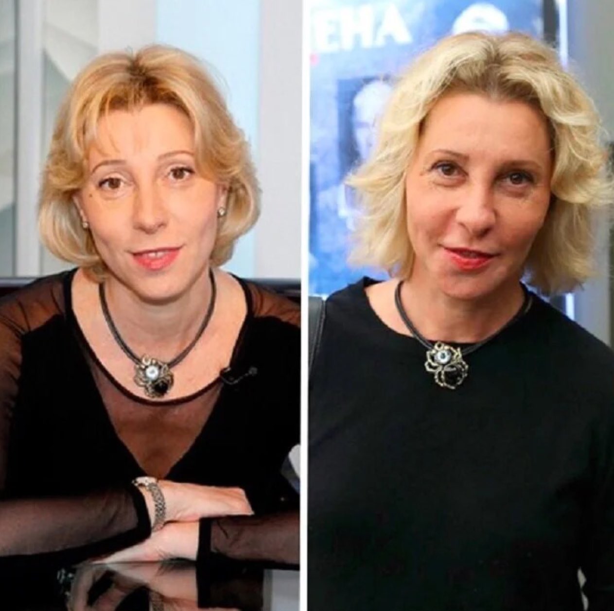 Юлия Рутберг до и после пластической операции