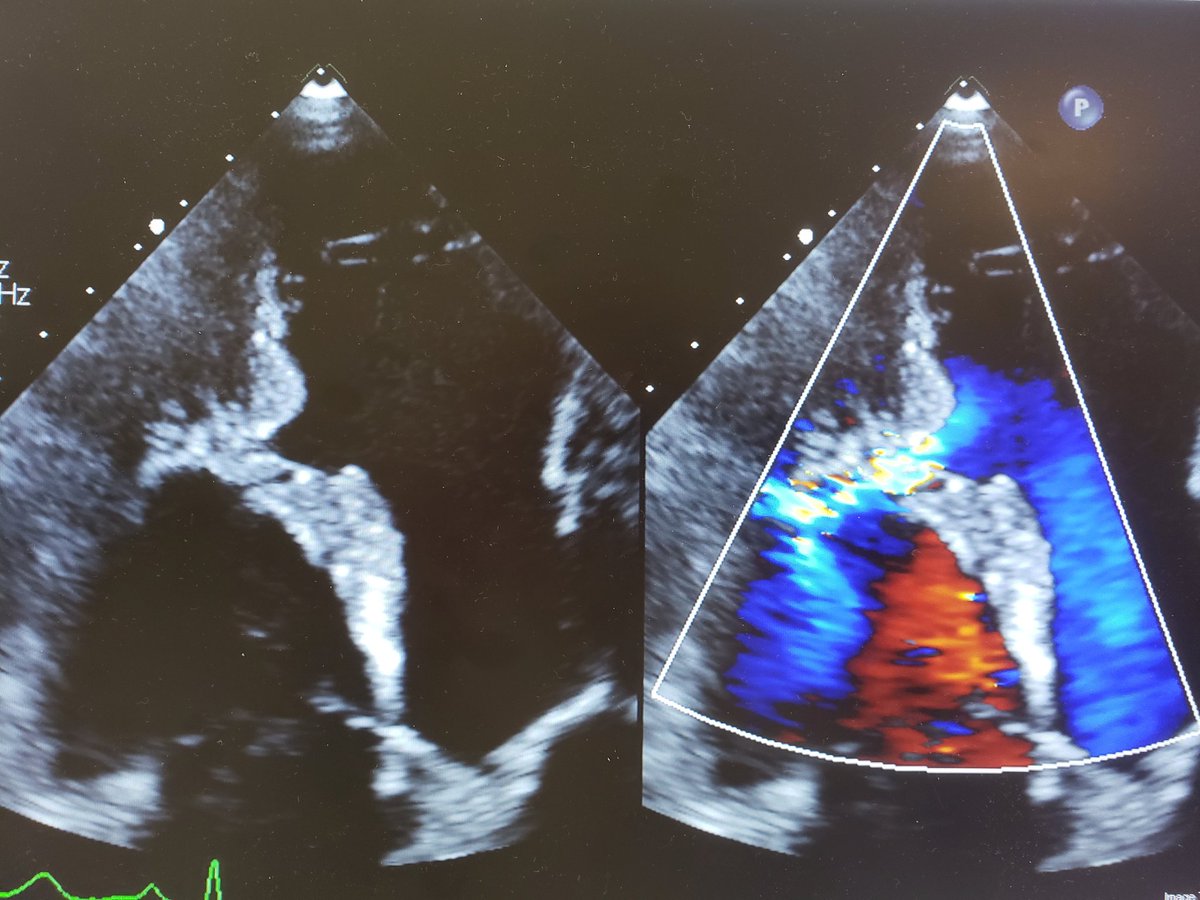 Not so subtle VSD seen in the clinic.  To close or not to close is always the question.