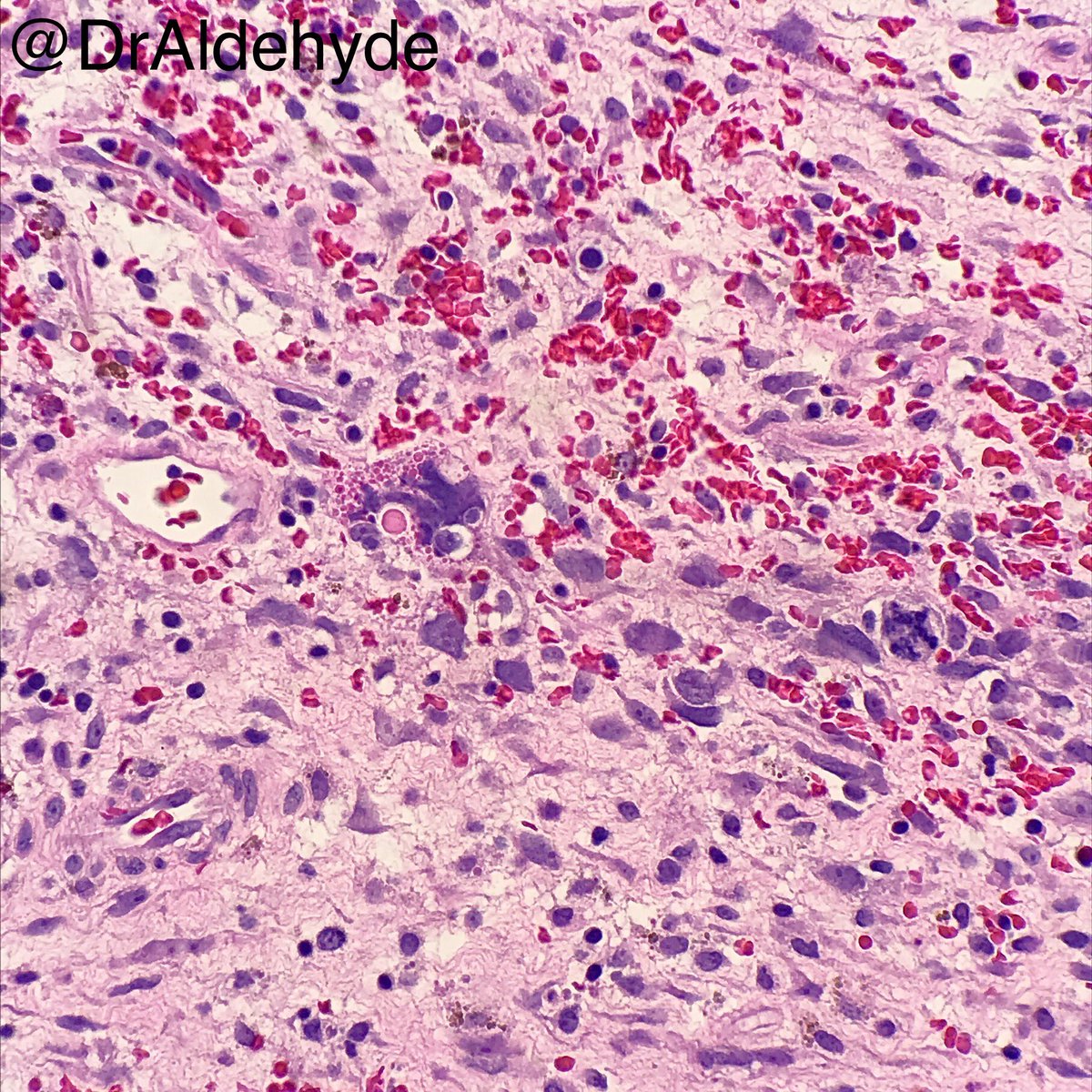 DrAldehyde's tweet photo. #HappyNewYearsEve special. 😆👍
These days I feel certain tumor cells can phagocytize other cells (eg., RBCs) and create hyaline globules. This could be an example of such (embryobal RMS)? Just another day of being #PathNerds 🤣
Happy New Year everyone! 🎉 https://t.co/K6TIPSVEcB