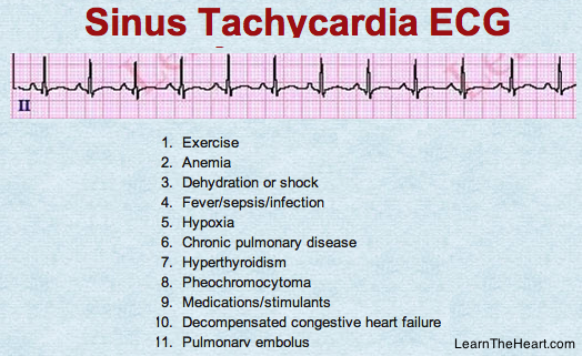 Learntheheart Com Sinus Tachycardia Ecg Rarely Primary Disorder Requiring Sa Node Ablation Treat Underlying Disorder Usmle