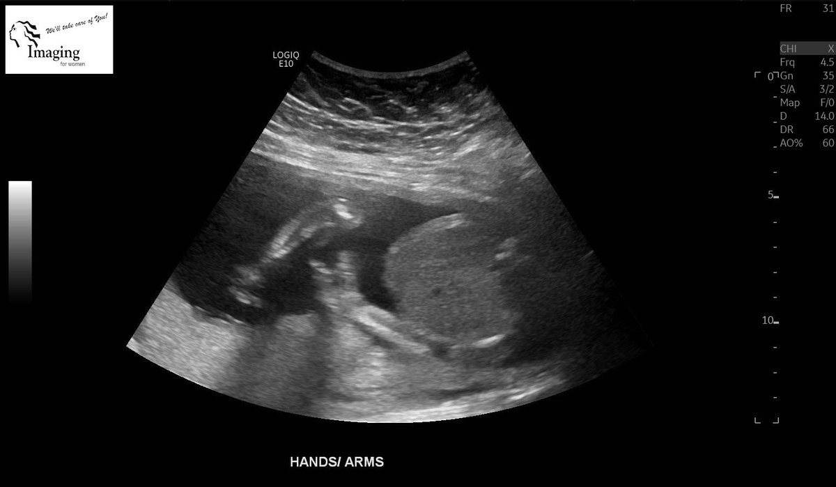 TravisCramsey's tweet photo. @cheetah @chiefs the newest member of our family is already a fan, and is hittin us with the ✌🏼 https://t.co/l9l2aFbBGv