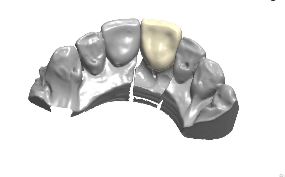 Dear sir
Ian Dental Design Studio, if you need to outsource design dental crowns, veneers, models, implants.
contact me .WeChat：+8618318409059/email：18318409059@163.com/WhatsAPP:+8618318409059