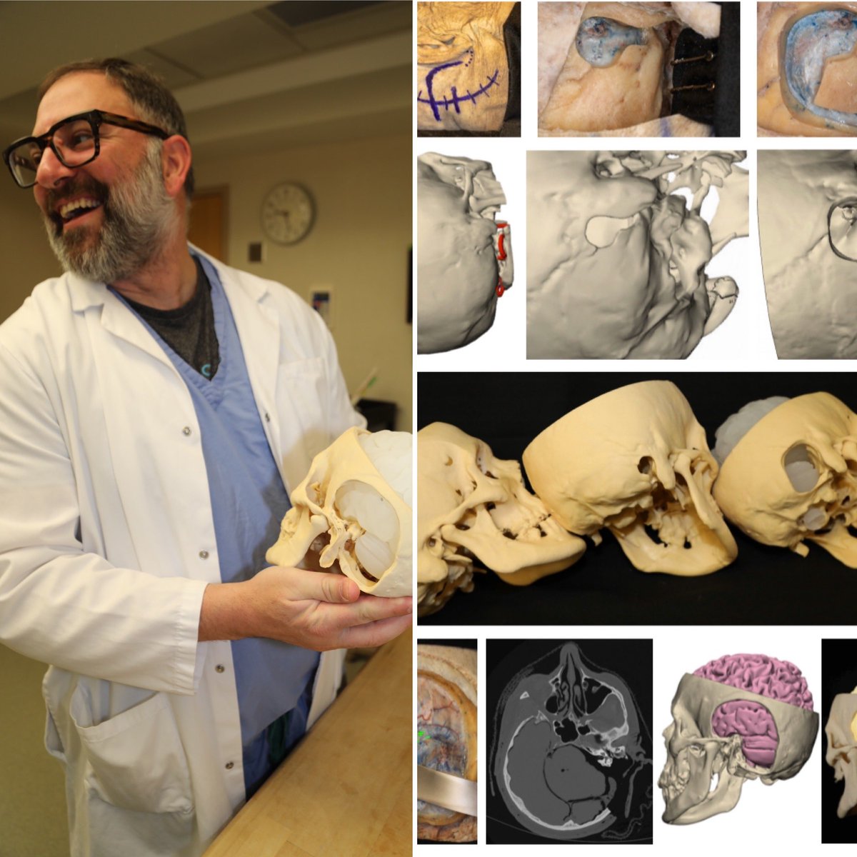 graffeo's tweet photo. In #2020 I finish my #chief year and start my #skullbase #fellowship- big steps in my early #nsgy career! #2019 saw a lot of exciting progress for our #MikesCrew team, esp in #simulation, #education, and #nsgy #EBM, which we are v excited to continue advancing in the years ahead! https://t.co/gVDvjTgm30